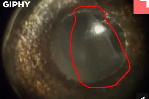 眼睛寄生虫图片